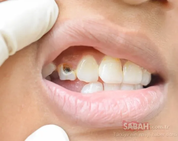 Dis Cekimi Ip Ile Tooth Extraction Youtube