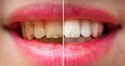 Dişleri beyazlatmanın doğal yolları