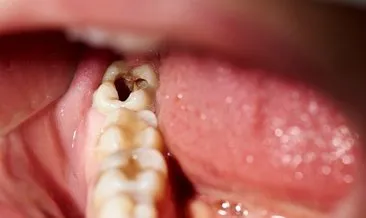 Çürük diş problemi olanlar dikkat! Bu besin çürük diş problemini ortadan kaldırıyor