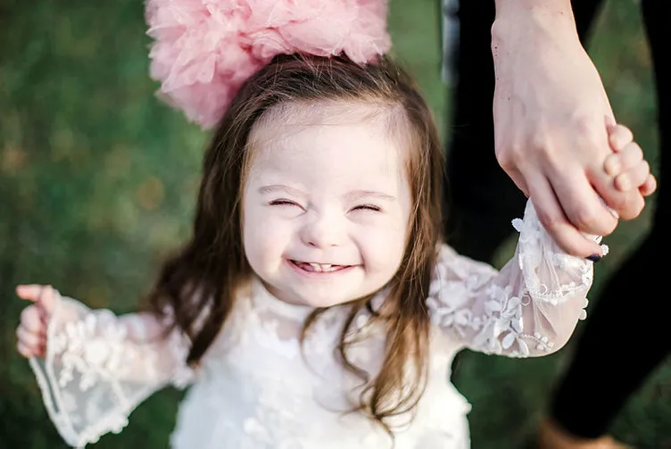 Gebelikte down sendromunun belirtileri… Sayfa 6 Gebelikte down sendromunun belirtileri… Sayfa 6