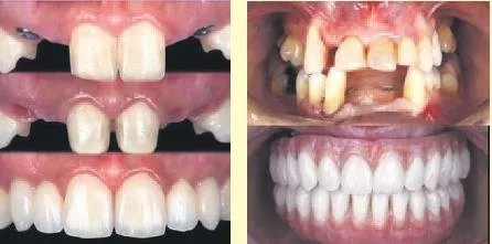 Eksik Olan Disin Yerine Neden Implant Yapilmali Dis Hekimi Ilker Erdogan