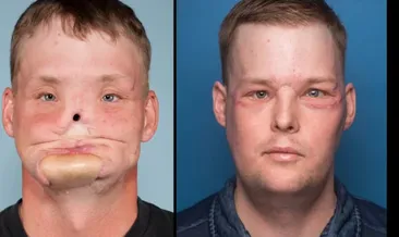 Yüzü paramparça olmuştu, İşte son hali...