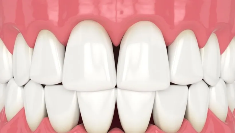 Dişlerinizin arasında oluşan siyah üçgenler ne anlama geliyor? Diş hekimi uyardı!