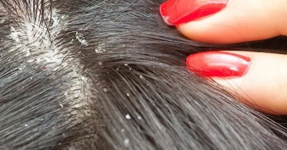 Evde Dogal Ve Bitkisel Tedavi Yontemleri Ile Kepek Nasil Gecer Sactaki Kepege Ne Iyi Gelir Saglik Haberleri Evde Dogal Ve Bitkisel Tedavi Yontemleri Ile Kepek Nasil Gecer Sactaki Kepege Ne Iyi Gelir Saglik Haberleri