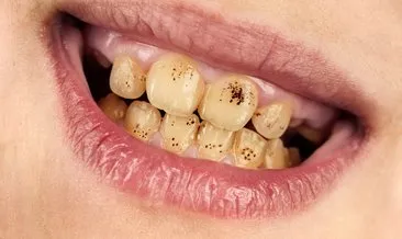 Diş minesinde kahverengi lekelere neden olabiliyor! O hastaların 6 ayda bir...