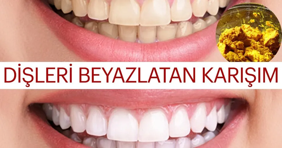uc dakikada dis beyazlatma yontemleri