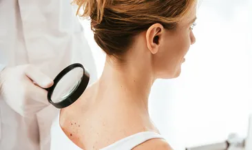 Sağlık Bakanlığı’ndan hayati uyarı! 25 yaşından sonra çıkan benlere dikkat!