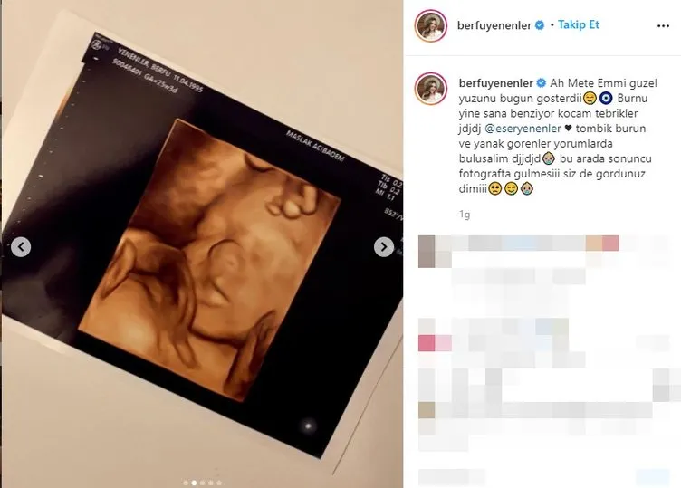 Berfu Yenenler bebeğinin ultrason görüntülerini paylaştı