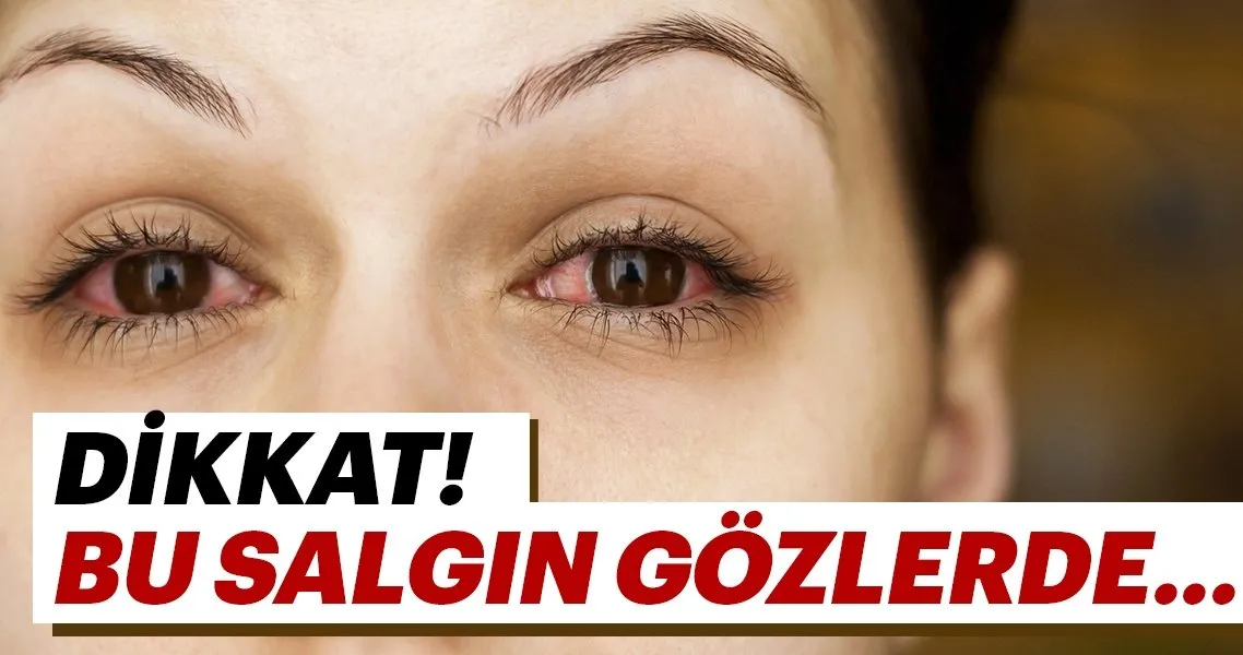 Dikkat Bu Salgin Gozlerde Saglik Haberleri