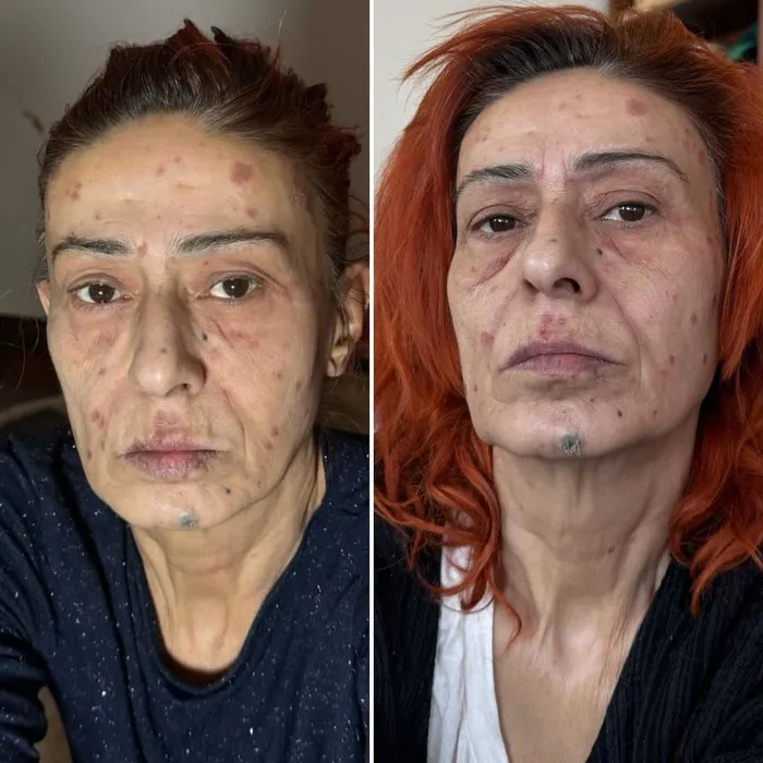 Yıldız Tilbe’nin yüzü yandı! Korkutan görüntüyü sosyal medyasında paylaştı: Geçer inşallah