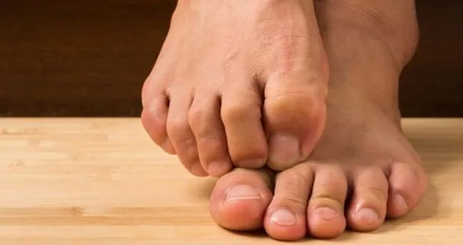 ayak mantari nasil gecer ve ne iyi gelir ayak basparmak tirnak mantari tedavisi saglik haberleri