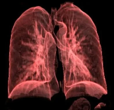 Akciğer kanseri nedir? Tedavisi, belirtileri