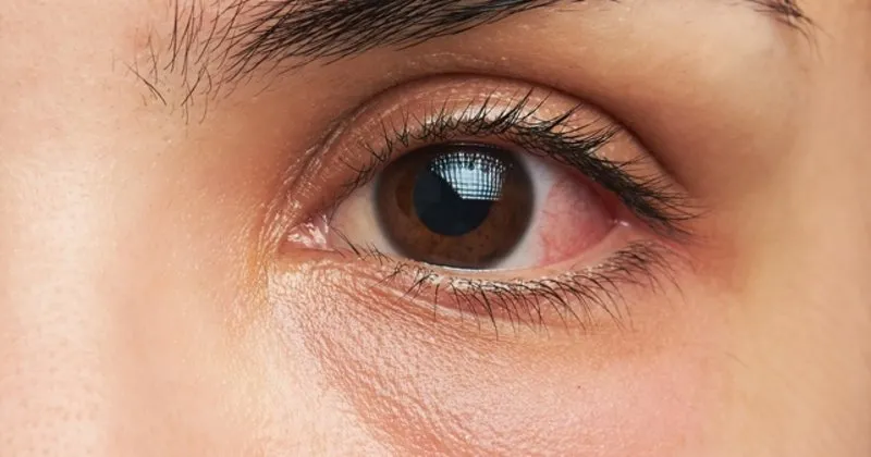 goz kizarikligi covid 19 belirtisi mi saglik haberleri