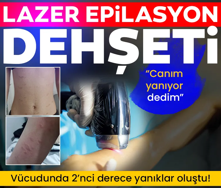 Lazer epilasyon dehşeti