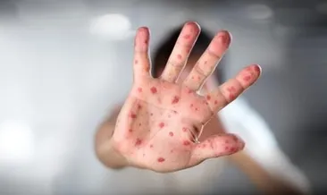 Kızamık salgını hortladı!