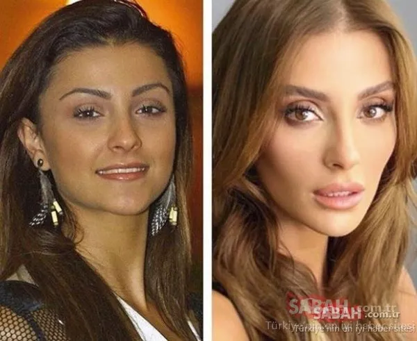 ozge ozberk estetiksiz hali