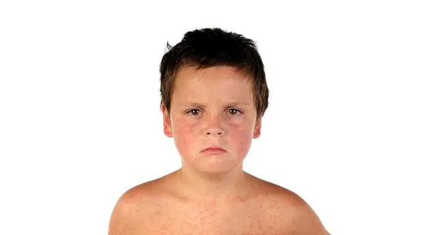 kizamik belirtileri nelerdir kizamik