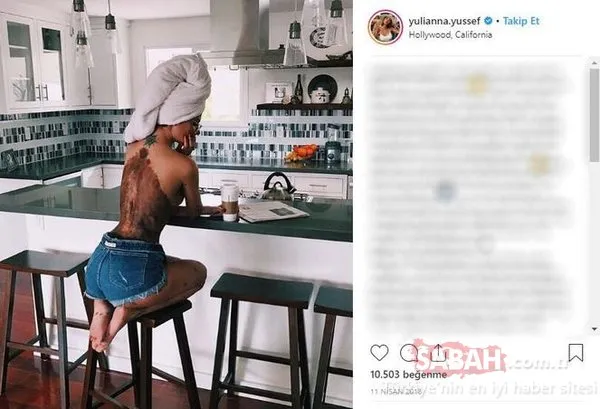Cildi yüzünden herkes alay ediyordu... Şimdi dünya markaları peşinden koşuyor!