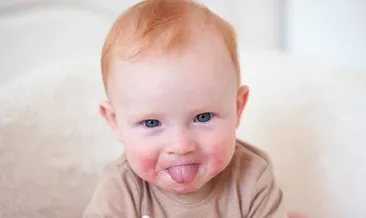 Cocuklarda Alerjiler Cocuk Haberleri