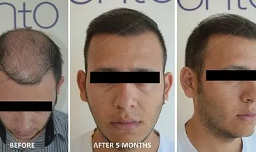 Sac Ekiminden Sonra Bunlari Asla Yapmayin Egeli Sabah Haberleri