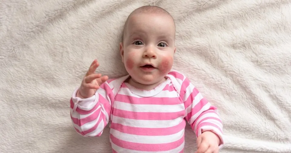 Cocuklarda Sik Gorulen Cilt Lezyonlarindan Biri Egzama Cocuk Haberleri