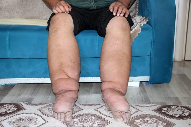 Milyonda bir görülen hastalığa yakalandı: Bacakları her yıl 7 santimetre genişliyor!