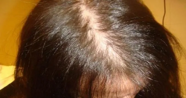 Kadinlarda Sac Dokulmesinin Nedenleri Sac Dokulmesi Neden Olur Saglik Haberleri