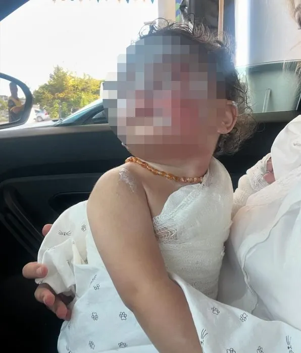 Anaokulunda üzerine kahve dökülen 1.5 yaşındaki Aden Aslan’da ikinci derece yanıklar oluştu! Kahrolan anne: Benim evladım acı çekiyor