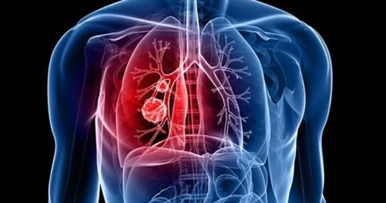 Akciğer iltihabı belirtileri nelerdir? Akciğer iltihabı nedir, neden olur?
