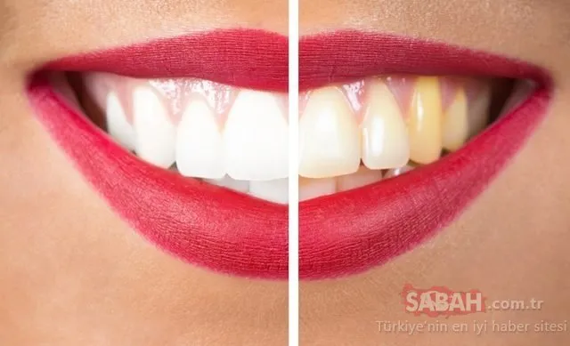 Evde diş beyazlatma yöntemleri neler? İşte o mucize teknikler…