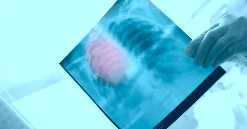 Tavi Yontemi Ile Kalp Kapagi Ameliyatini Kolaylastiriyor Saglik Haberleri