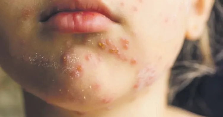 ABD’de kızamık vakaları 33 yılın zirvesinde