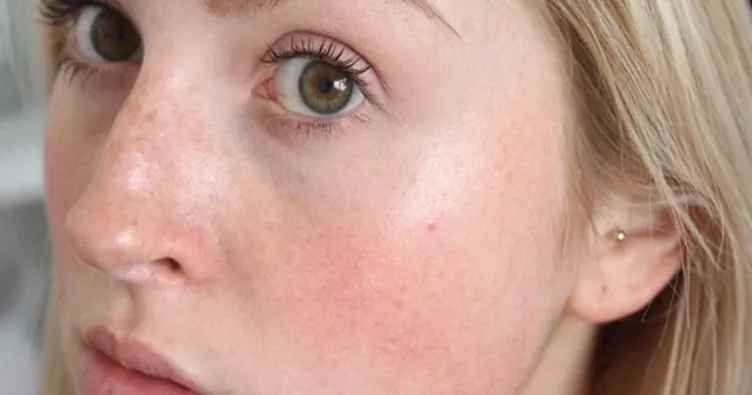 Yüz kızarması neden olur nasıl geçer?