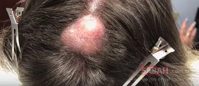 20 yıl bu şekilde yaşadı....Kafasından çıkanlar şoke etti!