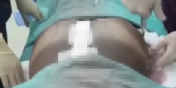 Estetik skandalı! Son dakika haberi: Kalça ameliyatı sonrası genç kızın hayatı kabusa döndü