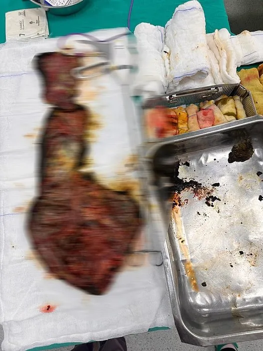 Şişlik sandı ama vücudundan çıkanlar şoke etti: Tam 90 cm... Böylesi tıp tarihinde görülmedi
