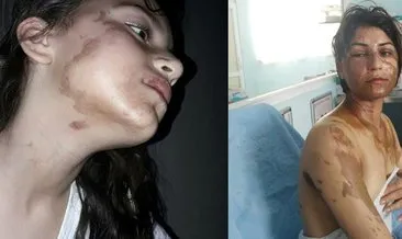 Uyuyan hala ve yeğenine asitli saldırı