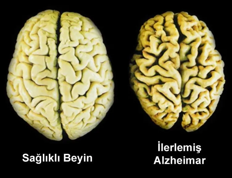 Alzheimer’la ilgili bunu daha önce hiç duymadınız!
