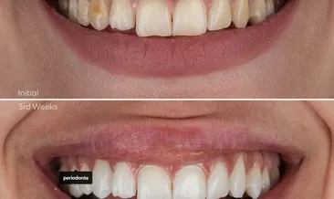 Ağız sağlığınız için cipsten uzak durun