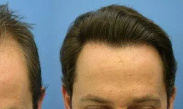 Saç ekimi nasıl yapılır?