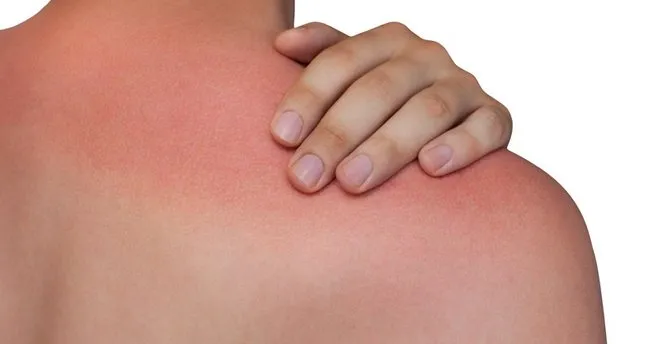 kizgin yag yanigina ne iyi gelir nasil gecer iste ciltteki gunes ve buhar yanigi acisini alan ve yaniga iyi gelen tedavi yontemleri saglik haberleri