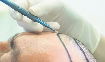 Yaz aylarında saç ekimi yapılır mı?