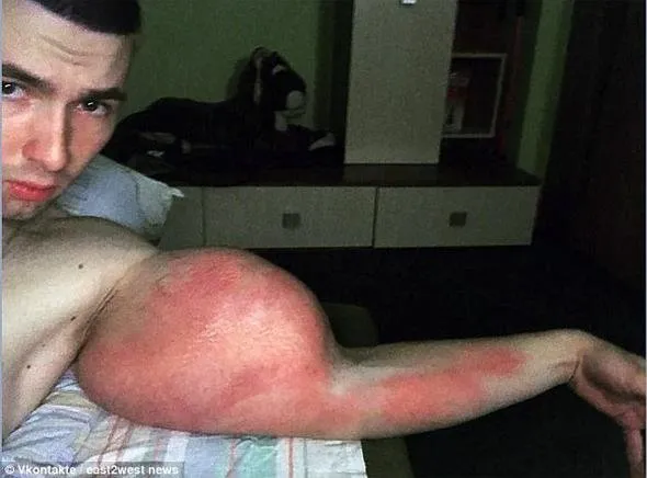 Kollarına enjekte ettiği sıvı nedeniyle kolları kesilebilir...