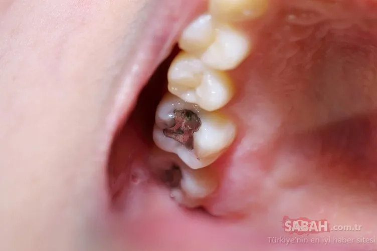 Kırk yıl düşünseniz aklınıza gelmez... Çürük dişleri tedavi ettiği ortaya çıktı!