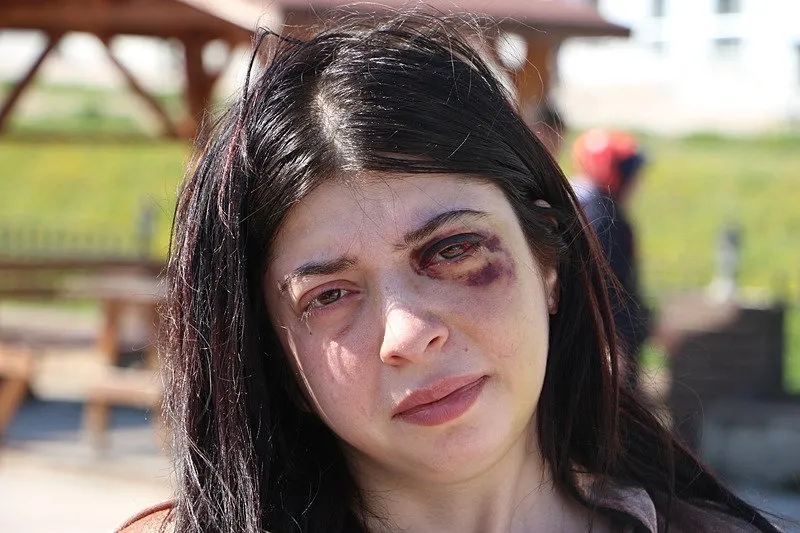 Samsun’da Damla Korkmaz sokak ortasında dehşeti yaşamıştı! “Yüzümde bir demirle sonsuza dek…”