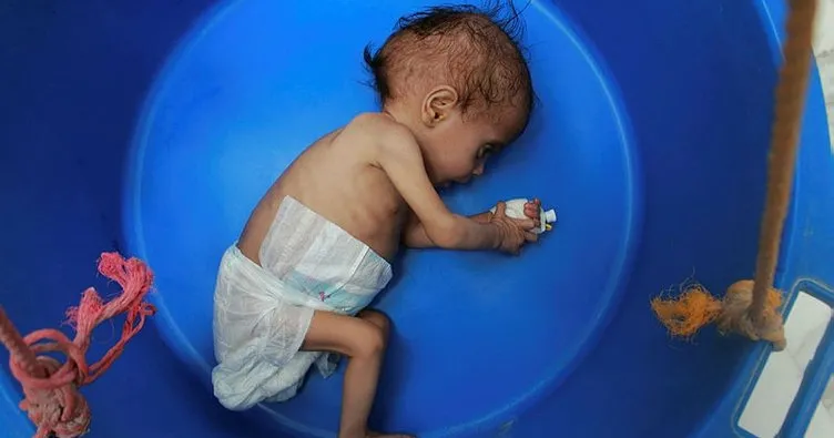 BM: Yemen’in güneyinde 98 bin çocuk ölüm riskiyle karşı karşıya