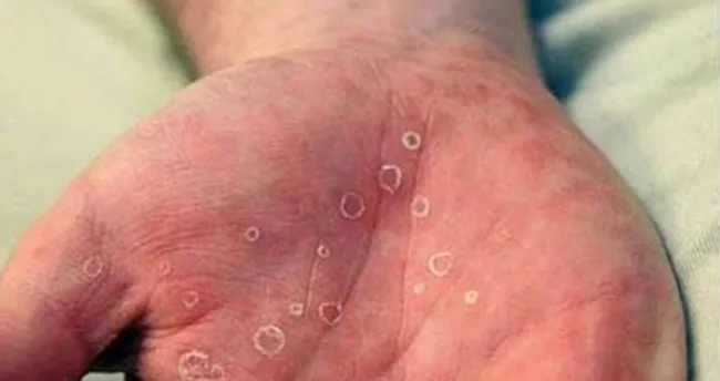 sifiliz nedir belirtileri nelerdir