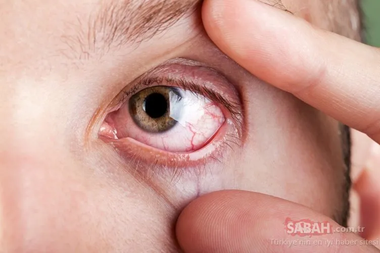 Sigaranın gözler üzerindeki yıkıcı etkileri…