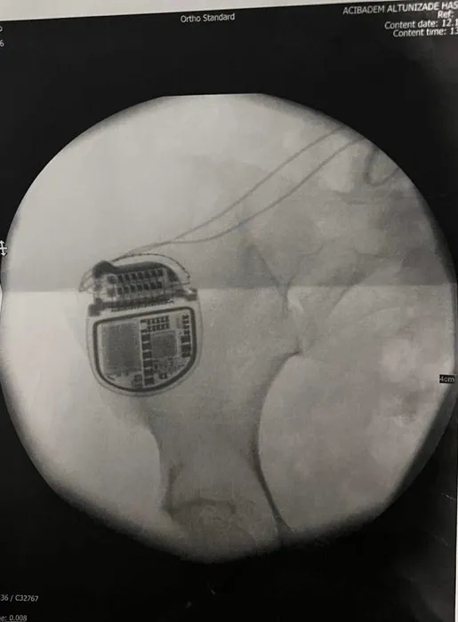 Yanlış operasyon sonrası genç kadın felç kalmıştı! Sorulardan kaçtı! Bülent Cihantimur sus pus...