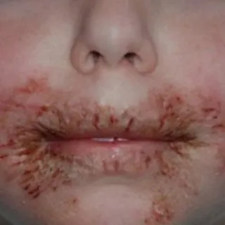 8 yaşındaki kızının yüzünde ciddi yaralar çıkıyordu... Doktor annenin araştırmasının sonucu korkunç oldu!